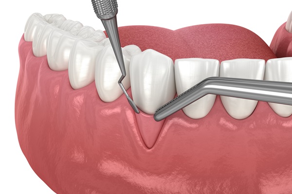 Gum Treatment