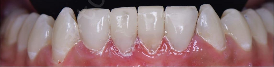 Before – Full Mouth Rehabilitation