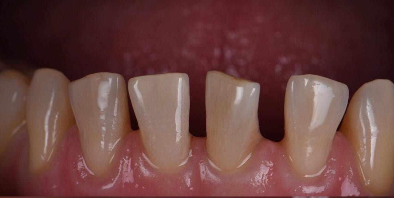 After – Composite Bonding