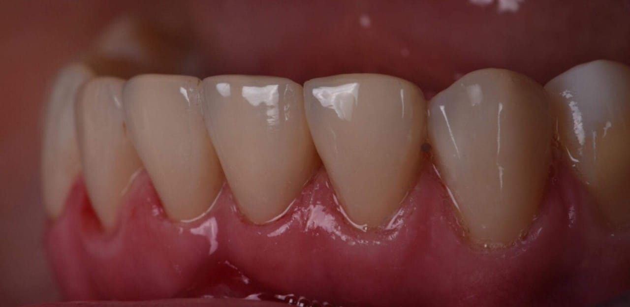 Before – Composite Bonding