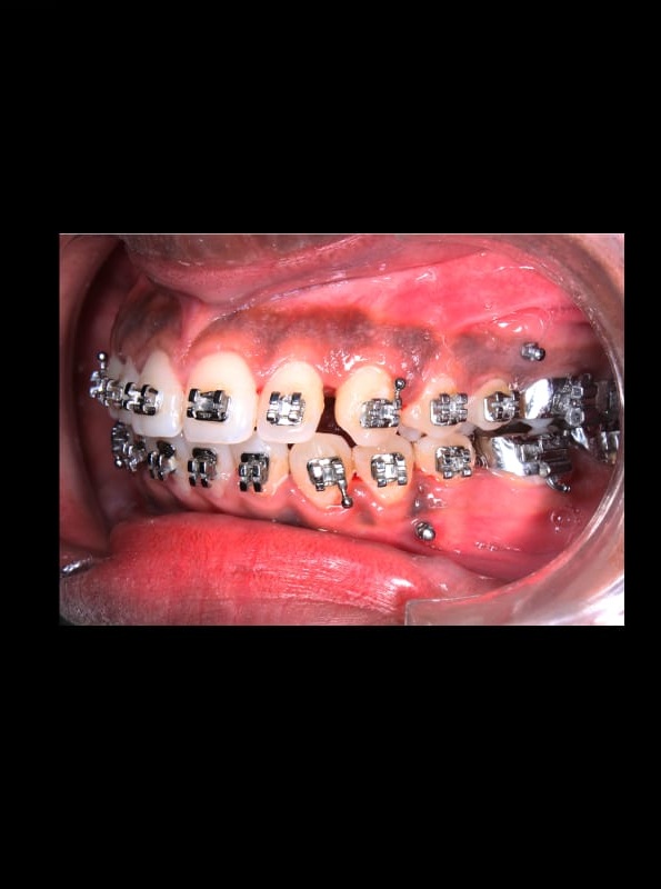 Before – Gum Contouring