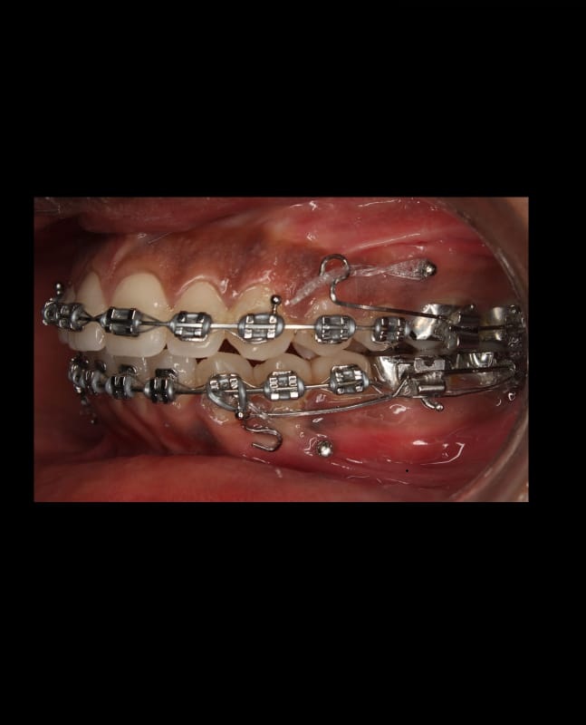 After – Gum Contouring