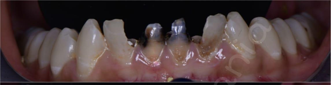 After – Full Mouth Rehabilitation